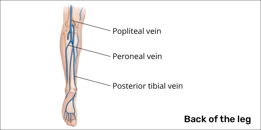 Deep vein thrombosis